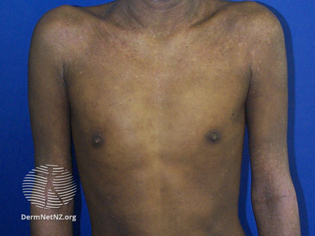 File:Atopic eczema (DermNet NZ dermatitis-at-derm11).jpg