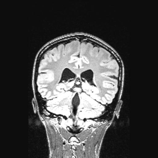 File:Atretic encephalocoele with inferior vermis hypoplasia (Radiopaedia 30443-31108 Coronal FLAIR 71).jpg