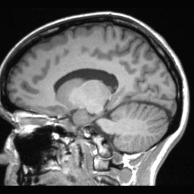 Atretic encephalocoele with inferior vermis hypoplasia (Radiopaedia 30443-31108 Sagittal T1 54).jpg