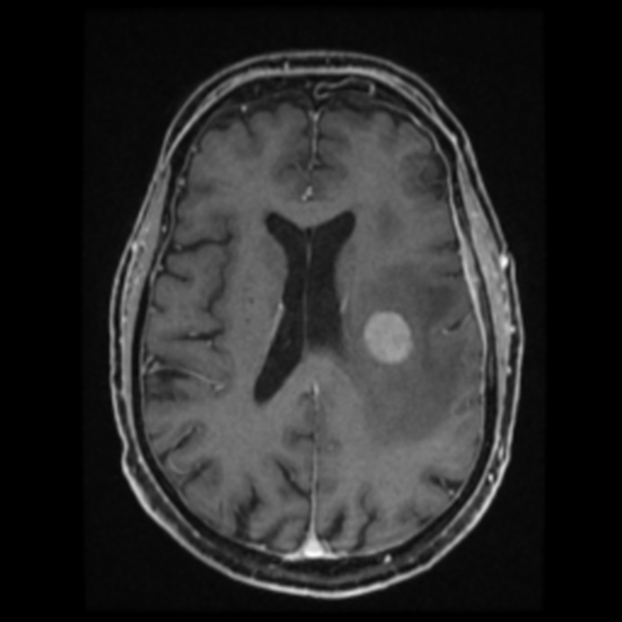 Atypical meningioma (Radiopaedia 45535-49629 Axial T1 C+ 43).jpg