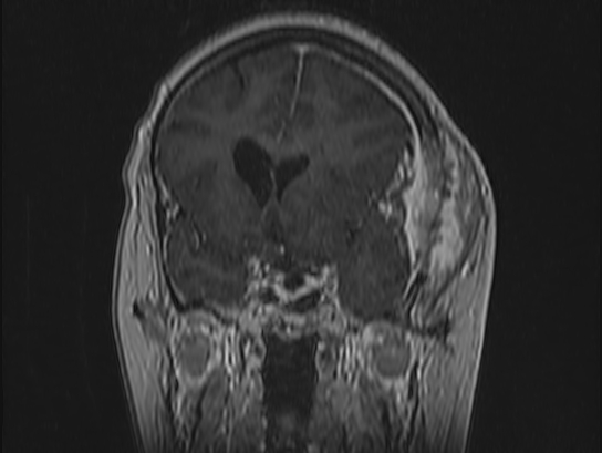 Atypical meningioma (Radiopaedia 62985-71406 Coronal T1 C+ 40).jpg