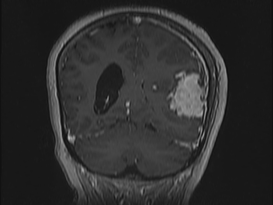 Atypical meningioma (Radiopaedia 62985-71406 Coronal T1 C+ 92).jpg