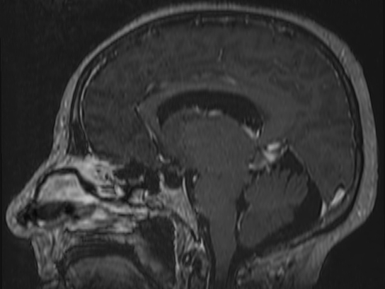 Atypical meningioma (Radiopaedia 62985-71406 Sagittal T1 C+ 43).jpg