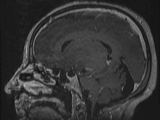 Atypical meningioma (Radiopaedia 62985-71406 Sagittal T1 C+ 50).jpg