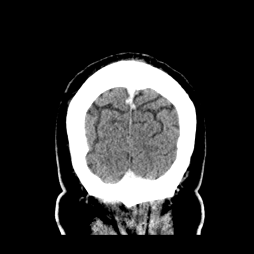 Atypical meningioma (WHO grade II) with brain invasion (Radiopaedia 57767-64728 Coronal C+ 57).png