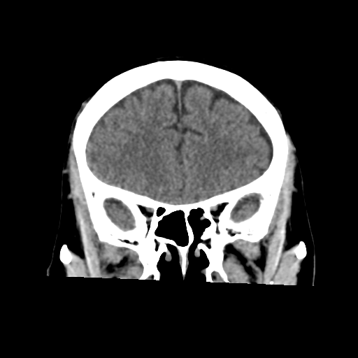 Atypical meningioma (WHO grade II) with osseous invasion (Radiopaedia 53654-59715 Coronal non-contrast 21).png