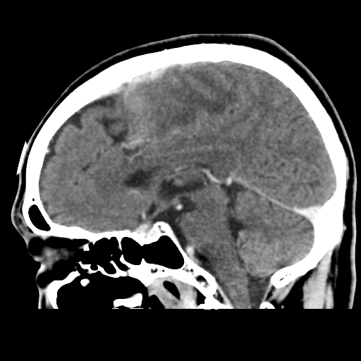 File:Atypical meningioma (WHO grade II) with osseous invasion (Radiopaedia 53654-59715 G 28).png