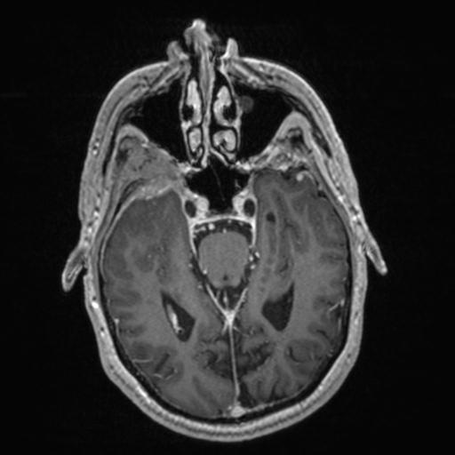 Atypical meningioma (grade II) - en plaque (Radiopaedia 29633-30147 Axial T1 C+ 74).jpg