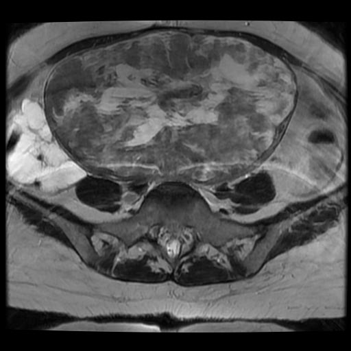 File:Atypical retroperitoneal lymphocoeles with large leiomyoma of uterus (Radiopaedia 32084-33027 Axial T2 11).jpg