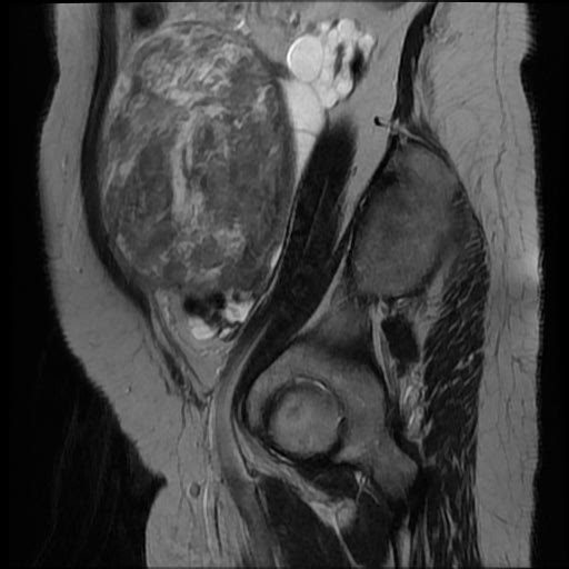 File:Atypical retroperitoneal lymphocoeles with large leiomyoma of uterus (Radiopaedia 32084-33027 Sagittal T2 6).jpg