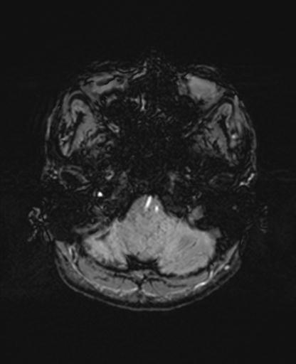 Autoimmune limbic encephalitis (Radiopaedia 30363-31005 SWI 11).jpg