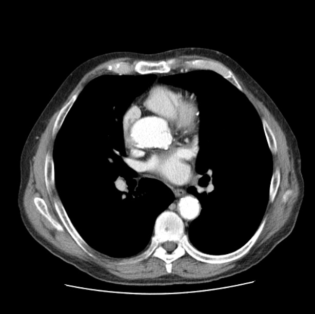 Autosomal dominant polycystic kidney disease (Radiopaedia 27851-28094 B 32).jpg