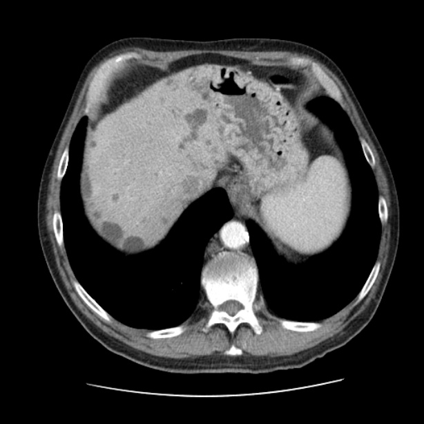 Autosomal dominant polycystic kidney disease (Radiopaedia 27851-28094 B 51).jpg