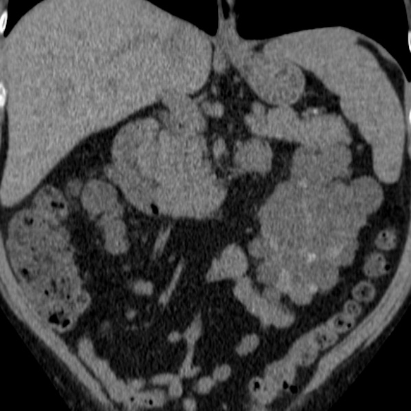 File:Autosomal dominant polycystic kidney disease (Radiopaedia 36539-38101 Coronal non-contrast 14).jpg