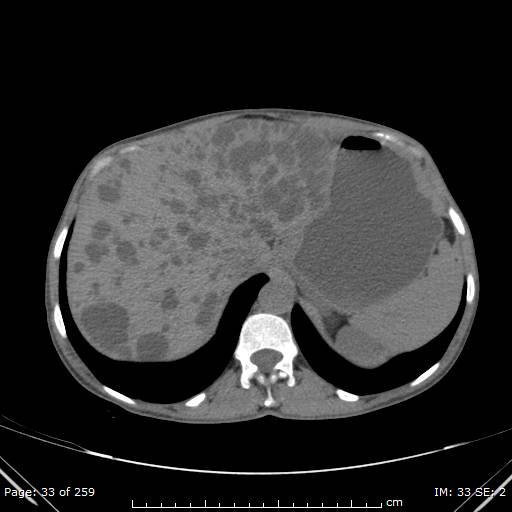 File:Autosomal dominant polycystic kidney disease (Radiopaedia 44122-47684 Axial 71).jpg