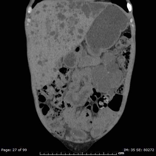 File:Autosomal dominant polycystic kidney disease (Radiopaedia 44122-47684 Coronal 19).jpg