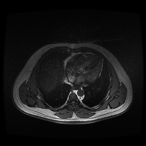 File:Autosomal dominant polycystic kidney disease (Radiopaedia 50259-55611 Axial 2D Dual Echo 5).jpg