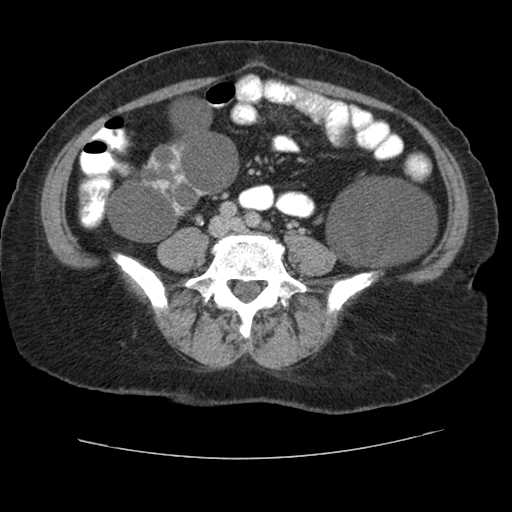 Autosomal dominant polycystic kidney disease with hepatic involvement (Radiopaedia 32693-33662 C 53).jpg