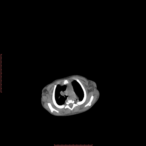 Autosomal recessive polycystic kidney disease associated with Caroli disease (Radiopaedia 61932-69984 Axial non-contrast 23).jpg