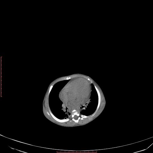 Autosomal recessive polycystic kidney disease associated with Caroli disease (Radiopaedia 61932-69984 Axial non-contrast 63).jpg