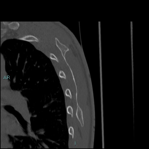 File:Avascular necrosis after fracture dislocations of the proximal humerus (Radiopaedia 88078-104653 Sagittal bone window 81).jpg