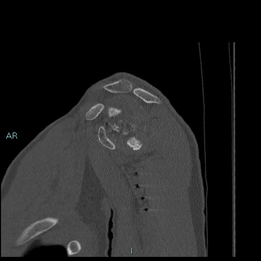 Avascular necrosis after fracture dislocations of the proximal humerus (Radiopaedia 88078-104655 Sagittal bone window 27).jpg