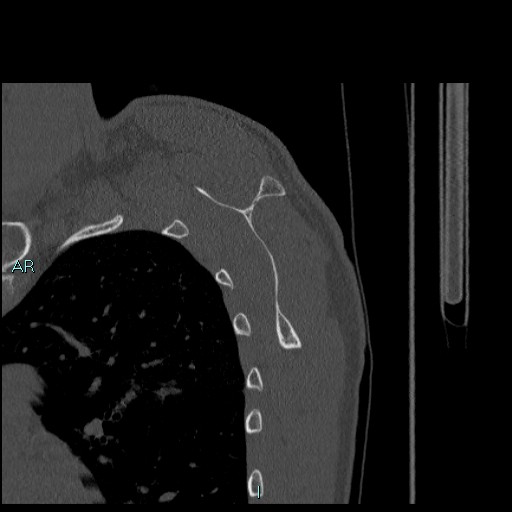 Avascular necrosis after fracture dislocations of the proximal humerus (Radiopaedia 88078-104655 Sagittal bone window 59).jpg