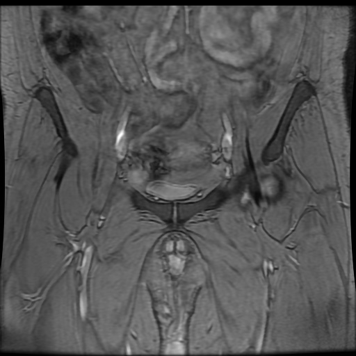 Avascular necrosis of the hip (Radiopaedia 61503-69465 F 17).jpg