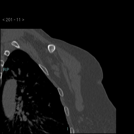 Avascular necrosis of the shoulder - Cruess stage I (Radiopaedia 77674-89887 Coronal bone window 10).jpg