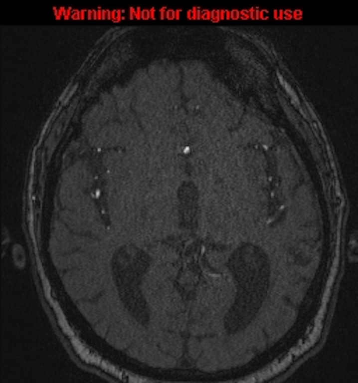 Azygos anterior cerebral artery (Radiopaedia 59325-66677 Axial MRA 83).jpg
