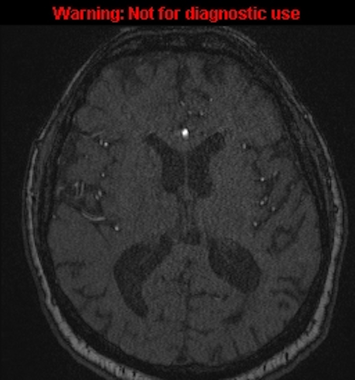 Azygos anterior cerebral artery (Radiopaedia 59325-66677 Axial MRA 97).jpg