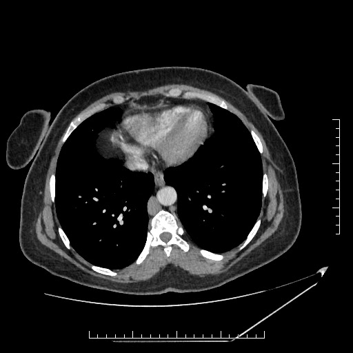 File:Azygos continuation of the IVC (Radiopaedia 40416-42965 A 1).jpg