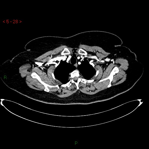 File:Azygos fissure and lobe (Radiopaedia 47620-52278 A 14).jpg