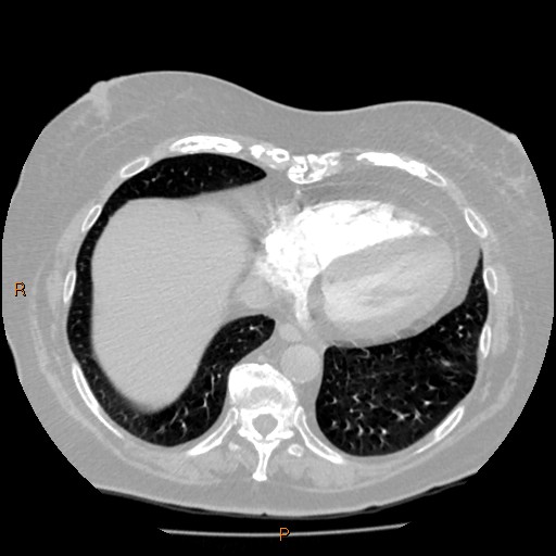 Azygos lobe (Radiopaedia 40161-42821 Axial lung window 57).jpg
