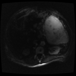 B cell lymphoma (Radiopaedia 56281-62954 Axial DWI 33).jpg