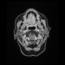 Balo concentric sclerosis (Radiopaedia 53875-59982 Axial LAVA C+ 12).jpg