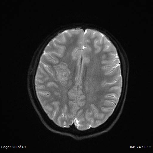File:Balo concentric sclerosis (Radiopaedia 61637-69636 Axial DWI 20).jpg