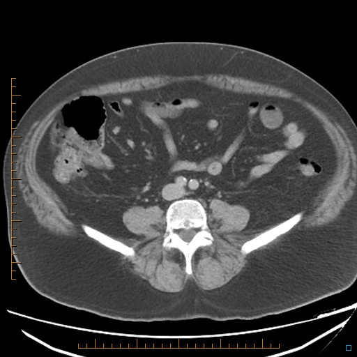 File:Bariatric balloon causing gastric outlet obstruction (Radiopaedia 54449-60672 A 26).jpg