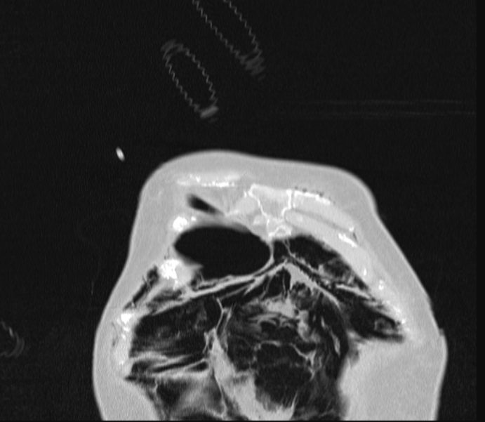 Barotrauma due to mechanical ventilation (Radiopaedia 28079-28336 Coronal lung window 10).jpg
