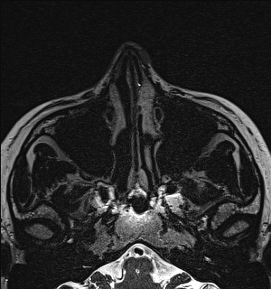 Basal cell carcinoma - nasal region (Radiopaedia 70292-80365 Axial Gradient Echo 24).jpg