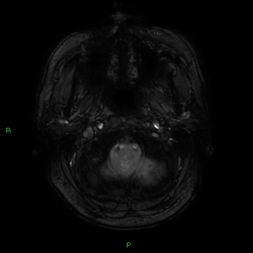 Basal ganglia hemorrhage (Radiopaedia 58346-65468 Axial SWI 3).jpg