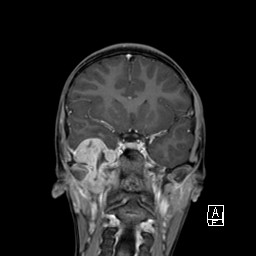 Base of skull rhabdomyosarcoma (Radiopaedia 32196-33142 I 33).jpg