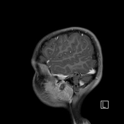Base of skull rhabdomyosarcoma (Radiopaedia 32196-33142 J 13).jpg
