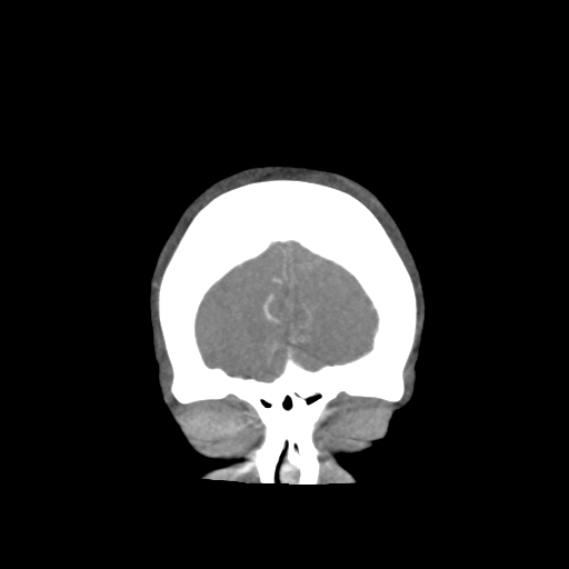 Basilar and bilateral vertebral artery occlusion (Radiopaedia 45592-49723 B 14).png
