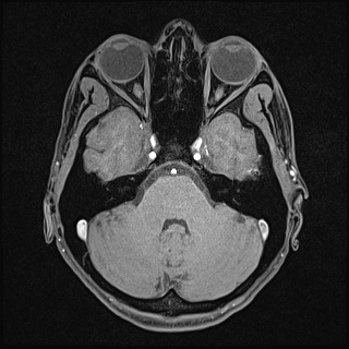 File:Basilar artery perforator aneurysm (Radiopaedia 82455-97733 Axial T1 fat sat 42).jpg