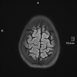 File:Basilar artery perforator aneurysm (Radiopaedia 82455-99523 Axial FLAIR 20).jpg