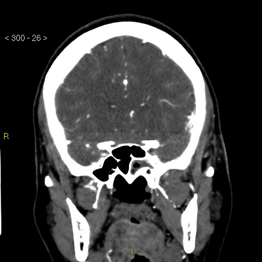 Basilar artery thrombosis (Radiopaedia 16260-15944 B 17).jpg