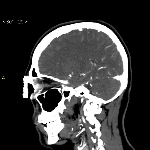 File:Basilar artery thrombosis (Radiopaedia 16260-15944 C 23).jpg