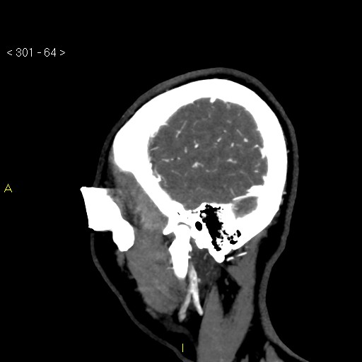 File:Basilar artery thrombosis (Radiopaedia 16260-15944 C 58).jpg
