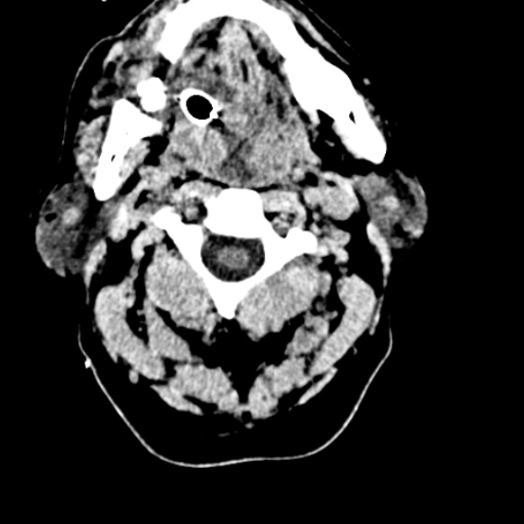 Basilar artery thrombosis (Radiopaedia 53351-59333 Axial non-contrast 3).jpg